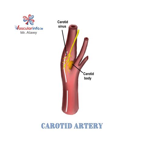 Carotid Body Tumor - Vascular Info