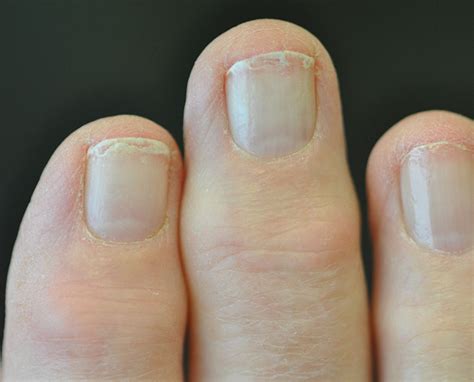 Fungal nail infection: diagnosis and management | The BMJ