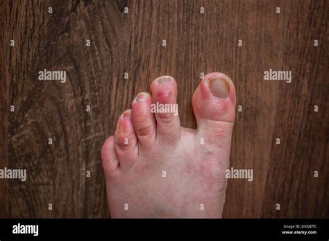 Raynaud's disease feet hi-res stock photography and images - Alamy