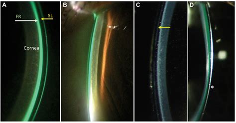 Sclerals 101: A Primer for Lens Fitting