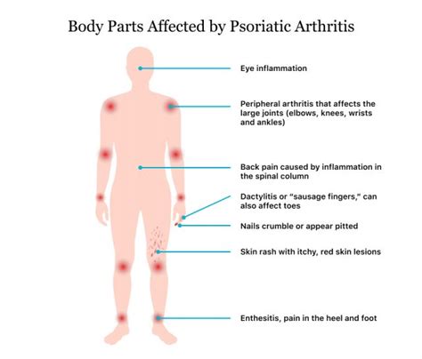 Psoriatic Arthritis | Symptoms, Causes, Diagnosis & Treatment