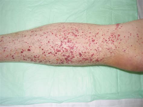 Vasculitis Skin Rash