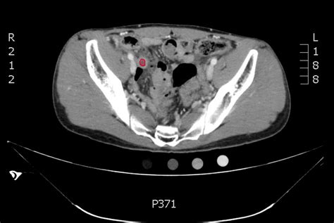 CT Diagnosis of Appendicitis - JETem