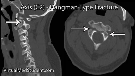 Hangman's Fracture | Medical Pictures | Pinterest | Radiology and Rad tech