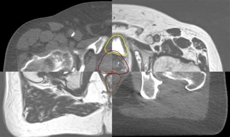 Cone Beam Ct Scan In Radiotherapy - The Best Picture Of Beam