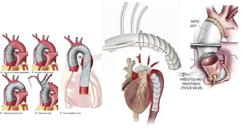 Surgery of the Aorta (Aortic Root, Ascending and Arch of the Aorta, Descending Thoracic Aorta)