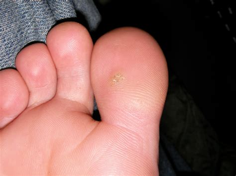 File:Toe plantar wart 0147.JPG