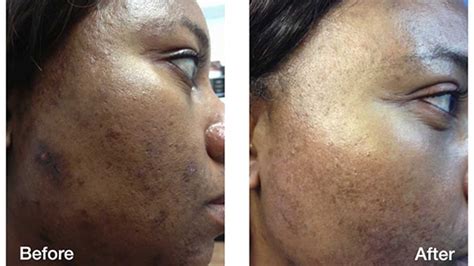 Skin Discoloration Treatment For Dark Skin in Seattle, WA