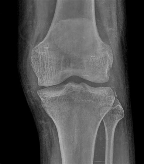 Segond fracture | Radiology Case | Radiopaedia.org | Radiology, Fracture, Case