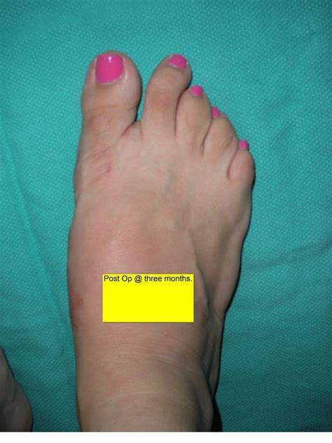 Before & After Foot Surgery - City Footcare NYC | NYC's Top Podiatrists