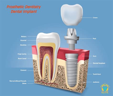 IMPLANT PROSTHETIC DENTISTRY - ELITE DENTAL CARE, TRACY | Elite Dental Care