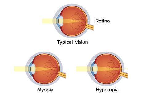 What’s the Difference Between Myopia and Hyperopia?