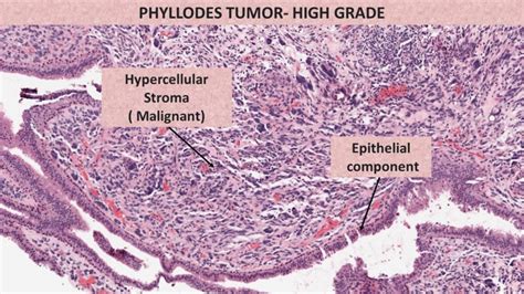 PHYLLODES TUMOR - Pathology Made Simple