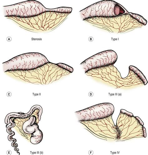 Duodenal and Intestinal Atresia and Stenosis | Obgyn Key