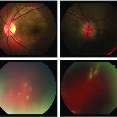 Ocular syphilis cases presented the Royal Victorian Eye and Ear... | Download Scientific Diagram