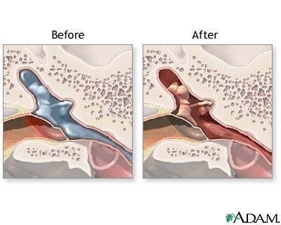 Who Needs Surgery to Insert Ear Tubes?: Life After Myringotomy Ear Operation, Ear Tubes, Middle ...