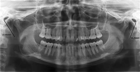 Styloid Process X Ray