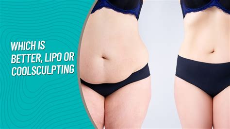 Liposuction Vs. CoolSculpting | Which Is Better, Lipo Or CoolSculpting 2024