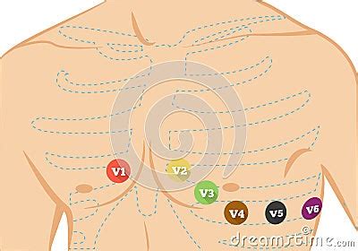 Chest Ecg Leads Placement Illustration. Six Colored Electrocardiography Leads Stock Vector ...