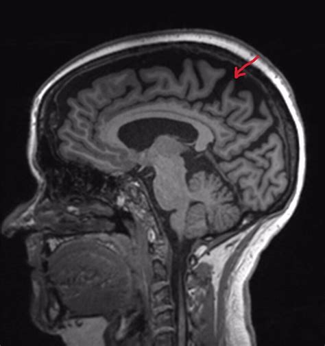 MRI Brain Sagittal T1 indicating generalised cortical atrophy with... | Download Scientific Diagram