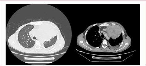 Thoracic tomodensitometry with injection of contrast medium, which... | Download Scientific Diagram