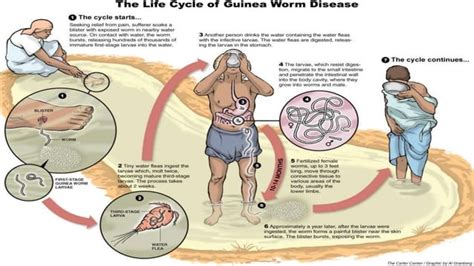 Dracunculiasis | PPT