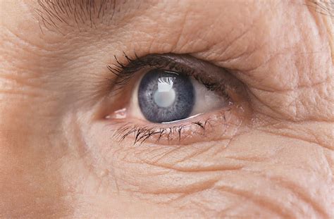 Congenital cataracts, types, causes and treatments - All About Vision