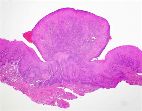 Oral Pyogenic Granuloma Histology