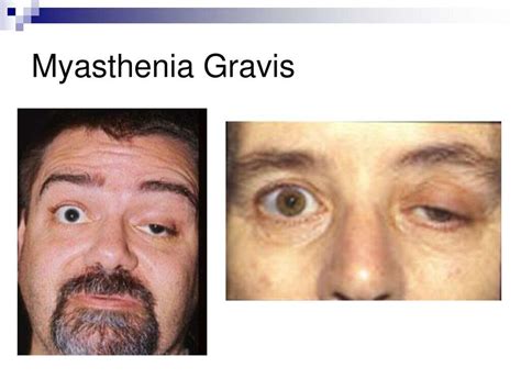 Myasthenia Gravis: 10 Symptoms of Myasthenia Gravis