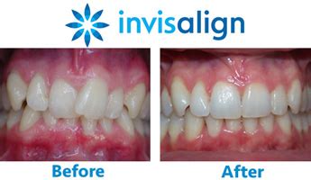 invisalign-straight-teeth-before-after-NY