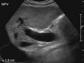 Ultrasound Assessment of the Hepatic Vasculature | Radiology Key