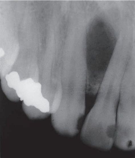 Globulomaxillary cyst - MEDizzy