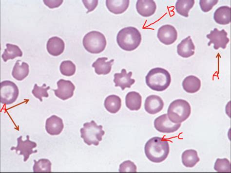 Blood smear Interpretations Flashcards | Quizlet