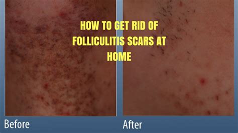 HOW TO GET RID OF FOLLICULITIS SCARS AT HOME. - YouTube