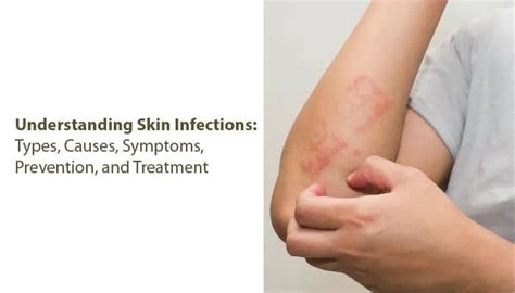 What are Common Symptoms and Treatments for Fungal Skin Infections?, fungal rash from sports bra ...