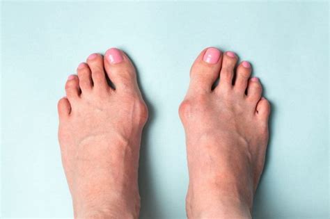 Sharp Pain in Feet: Symptoms of Arthritis in Toes – SAPNA Pain ...