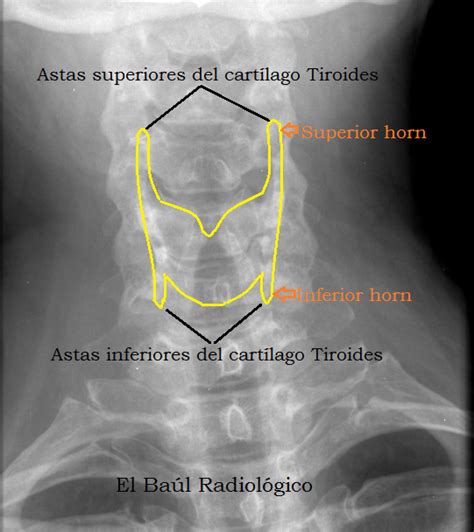 El Baúl Radiológico: CALCIFICACIONES SEUDOTUBULARES DEL CARTÍLAGO TIROIDES (Bilateral Thyroid ...