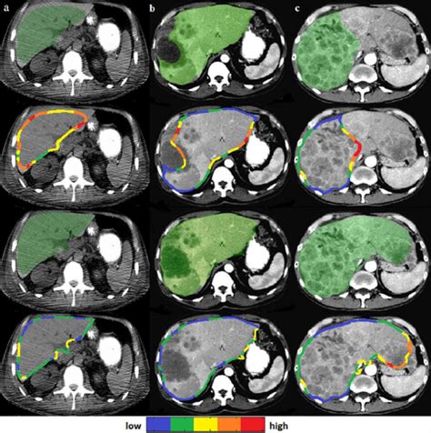 Liver Segments Ct Scan