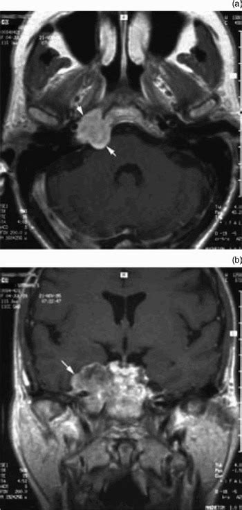 Chondrosarcomas of the skull base and temporal bone | The Journal of ...