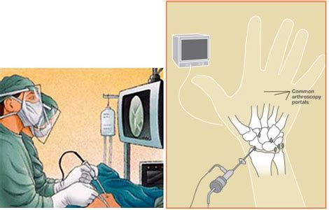 Hand Surgery Associates – What is Wrist Arthroscopy?