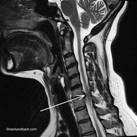 Lateral Cervical MRI of Disc Herniation | Dr Donald Corenman | Colorado ...