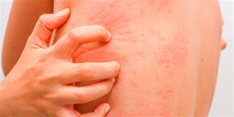 Itchiness or Rash | Q Dermatology