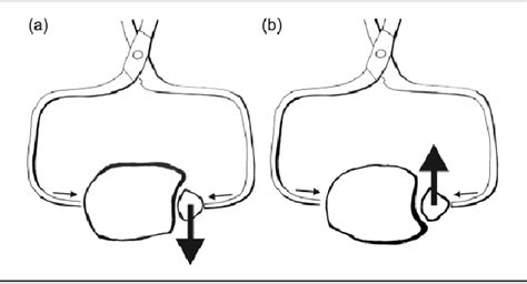 Figure 1 from Correlation of Incisura Anatomy With Syndesmotic Malreduction | Semantic Scholar