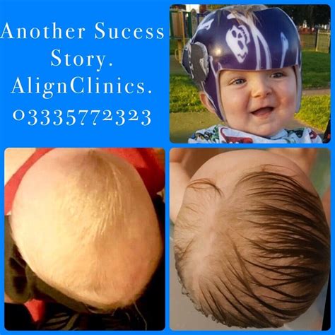 Plagiocephaly, Brachycephaly, Flat Head Syndrome Helmet Treatment for ...