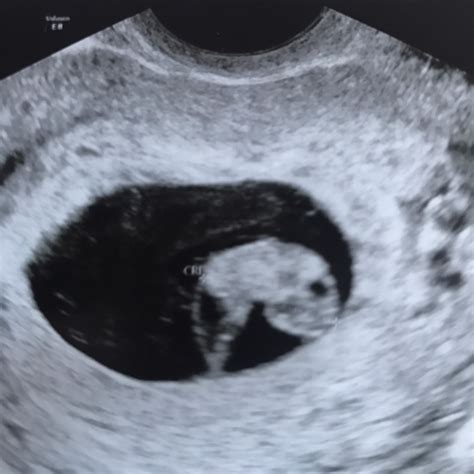 8 week scan. Boy or girl ? (transvaginal ultrasound) - Glow Community