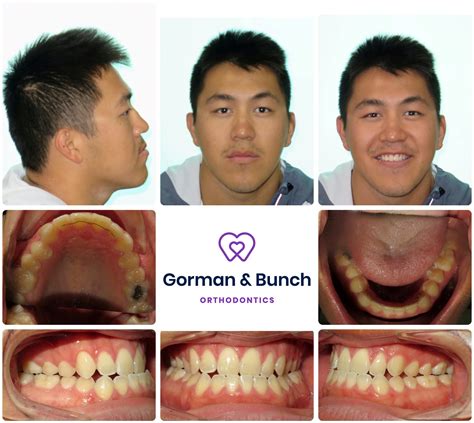 Invisalign Before and After Stories With Our Patients – Gorman & Bunch