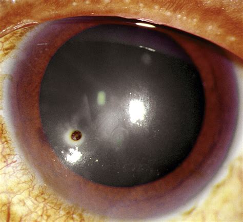 Foreign Body, Corneal | Anesthesia Key