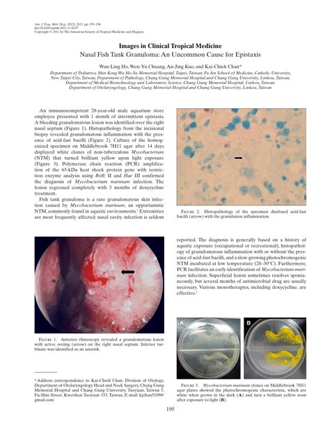 (PDF) Nasal Fish Tank Granuloma: An Uncommon Cause for Epistaxis