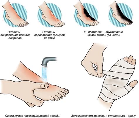 Degrees of burns with boiling water: symptoms and treatment | Health 2024