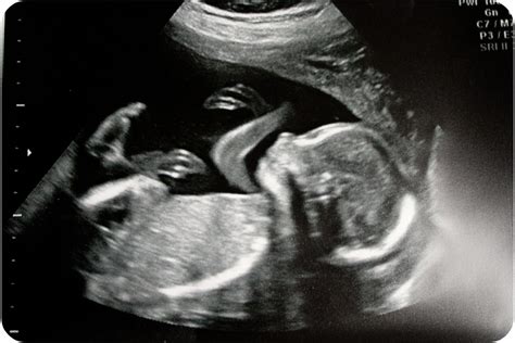 Baby boy #2, 20 week ultrasound | Alicia's Homemaking | Flickr